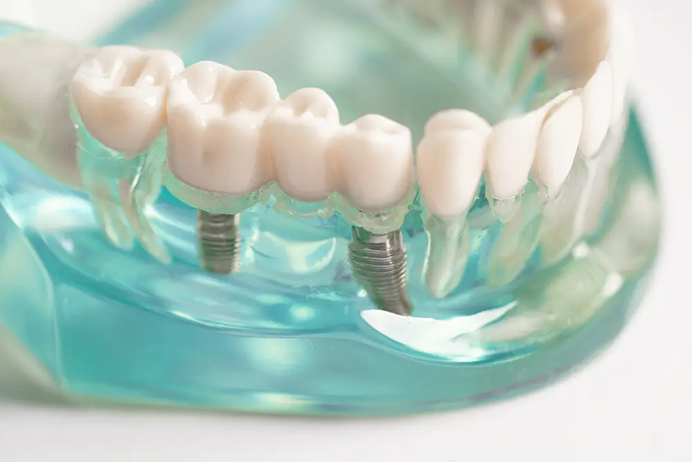 #1 Tooth Implant In Islamabad | Oracare Dentistry