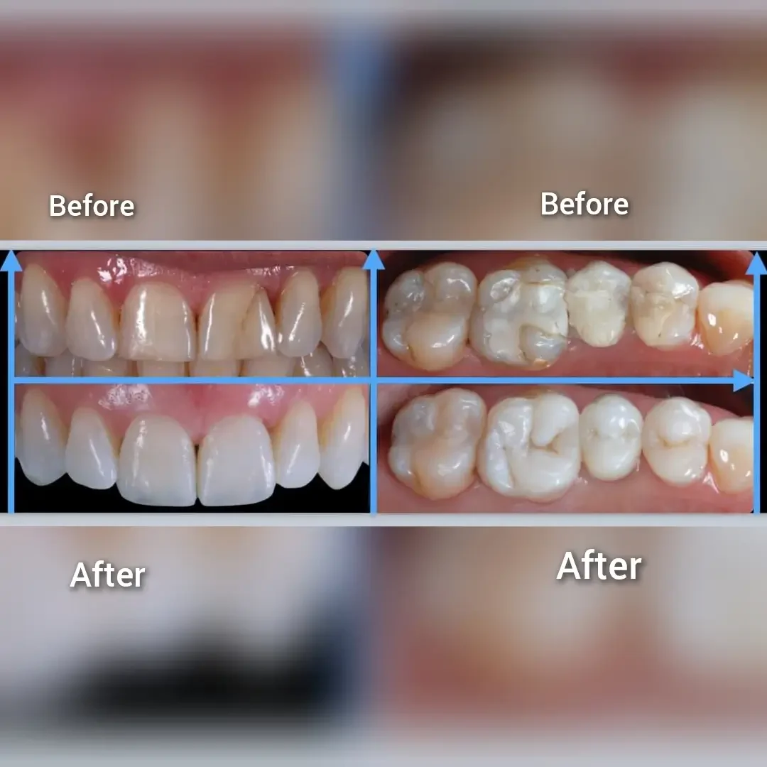 Anterior and Posterior composite fillings