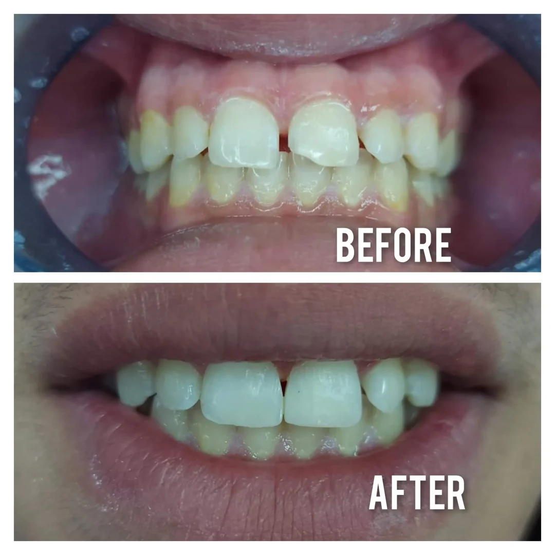 Anterior composite fillings