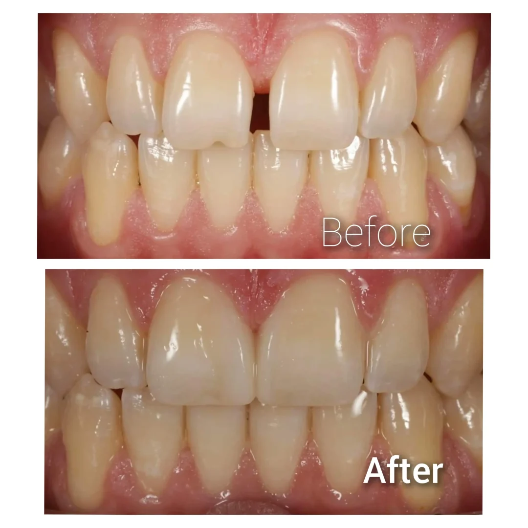 Anterior composite fillings(1)