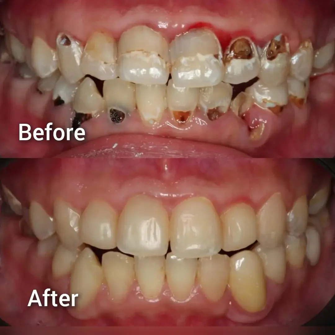 Anterior composite restorations