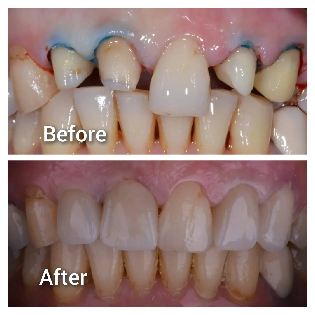 Anterior zirconia crowns