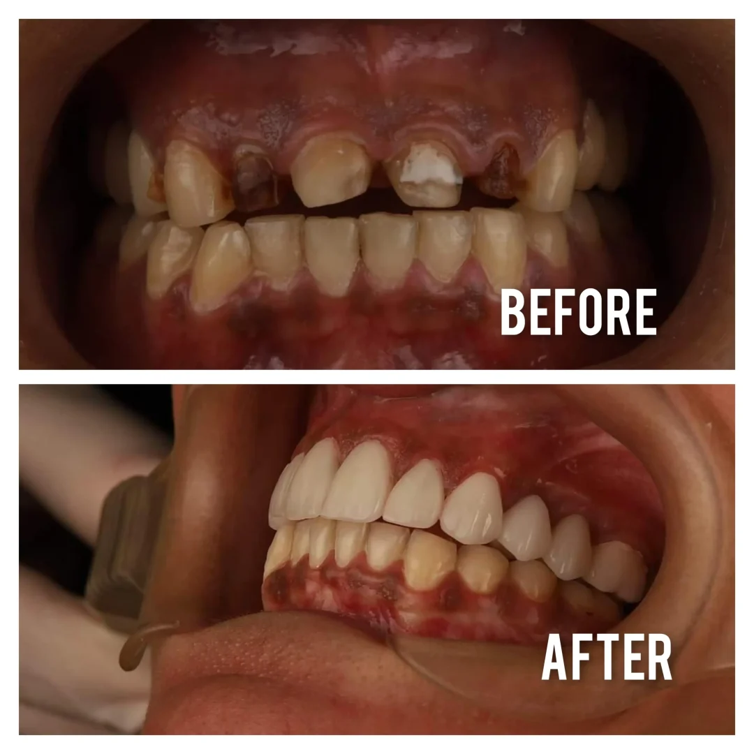 Full mouth rehabilitation with zirconia bridges