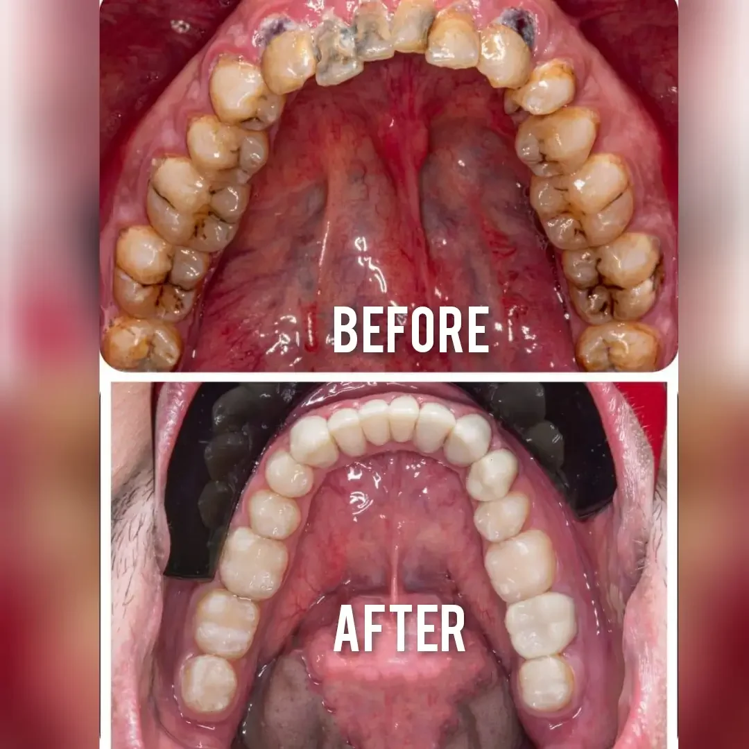 Full mouth rehabilitation with zirconia crowns and Composite fillings