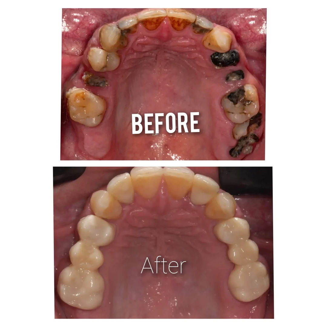 Full mouth rehabilitation with zirconia crowns and bridges