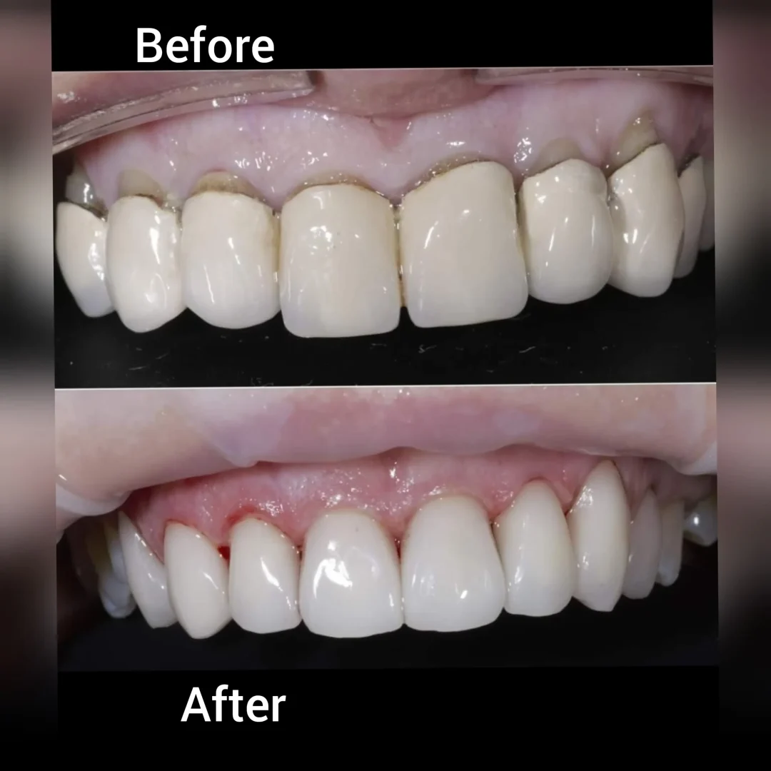 Replacing old and ill fitting pfm bridge with CAD CAM Zirconia bridge